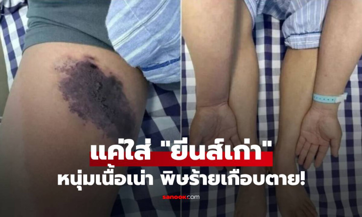 ช็อกสุดขีด! ใส่กางเกงยีนส์เก่าแป๊บเดียว เนื้อขาเน่าเปื่อยเกือบตายคาที่ พิษแมงมุมแพร่กระจายวุ่นวาย - fahbvip