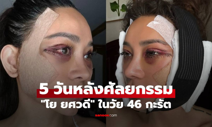 47 แล้วยังไงใครแคร์! โย ยศวดี บินเกาหลี Full Face Lift ครั้งแรก หน้าเด็กลงกว่าเดิม แค่ 5 วันแล้วเปลี - fahbvip