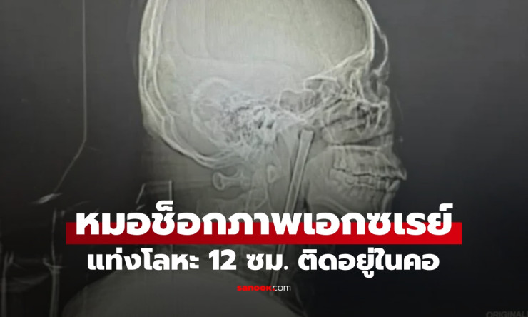 ช็อกสุดขีด! ตะเกียบโลหะยาว 12 ซม. ฝังคอผู้ชายจีนนาน 8 ปี ทีมหมออ้าปากค้าง - fahbvip