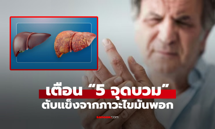 เมื่อไขมันบุกรุกทำลายตับ ร่างกายบวม 5 จุด เตือนมีแค่ 1 จุด ก็ควรรีบพบแพทย์! - fahbvip