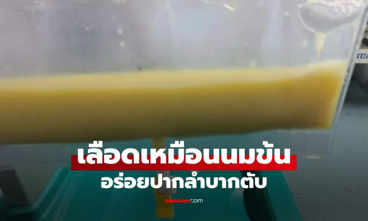 เลือดเหมือนนมข้น! หนุ่มวัย 34 เกือบตายเพราะเมนูโปรด อร่อยปากแต่ลำบากตับ - fahbvip