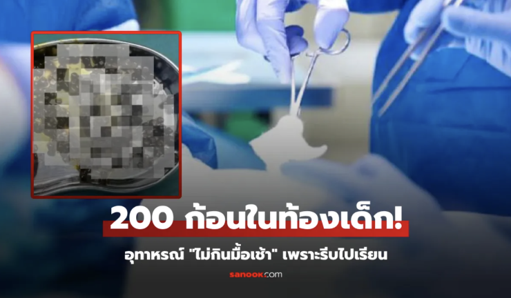 ลูกสาว 10 ขวบ ไม่กินมื้อเช้า พ่อแม่ช็อก ผ่าสิ่งนี้จากท้อง 200 ก้อน แพทย์ยังตกใจทั้งทีม! - fahbvip