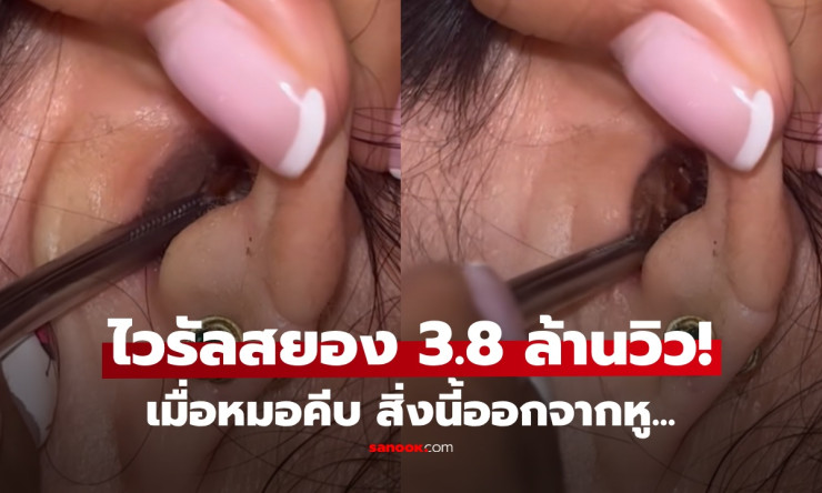 ขนลุกสุดขีด! ปวดหูเรื้อรัง คิดว่าแค่ขี้หูตัน หมอคีบออกมา... แมลงสาบตัวโต! เจ้าตัวยังร้องไห้กลัว - fahbvip