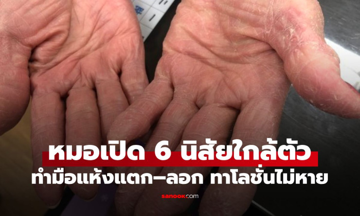 หมอเตือน! มือแห้งแตกลอก ทาโลชั่นไม่หาย อาจแพ้พฤติกรรม 6 ข้อนี้จนผื่นอักเสบกำเริบ - fahbvip