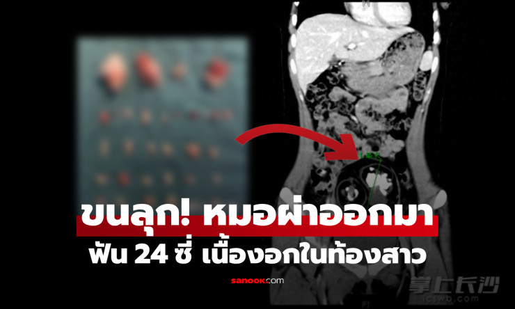 ช็อกสุดขีด! สาว 18 ผ่าท้องเจอฟัน 24 ซี่ในเนื้องอก หมออึ้งหนัก ไม่ใช่ผีไสย แต่เป็นโรคสยองแบบนี้! - fahbvip