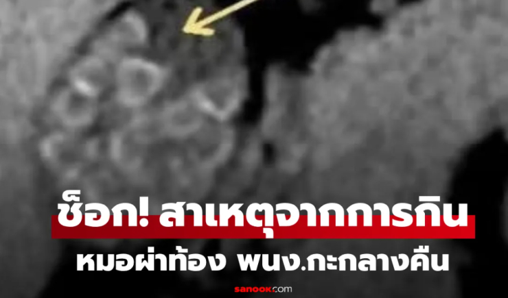 ผ่าท้องหญิง พนักงานกะดึก แพทย์สะพรึง เหมือนเปิดกล่องสุ่มคริสตัล ขนลุกสาเหตุจากการกิน!!! - fahbvip