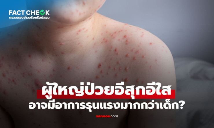 เช็กให้ชัวร์! ผู้ใหญ่เป็นอีสุกอีใส อาการหนักกว่าเด็กจริงไหม กรมควบคุมโรคตอบชัด - fahbvip