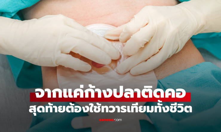 สยอง! ก้างปลาติดคอ กลืนข้าวดันลงท้อง สุดท้ายต้องทำ ทวารเทียม ใช้ชีวิตตลอดกาล อย่าหลงเชื่อโบราณอีกนะเ - fahbvip