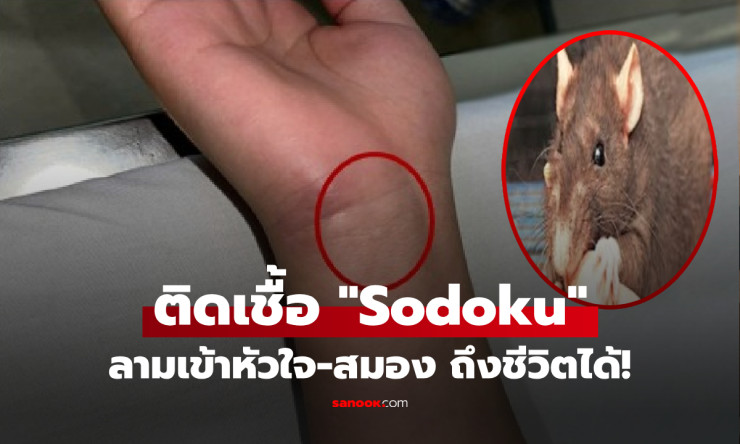 หนูกัดเด็ก 16 ไข้พุ่งสูง! ติดเชื้อ Sodoku รุนแรง ลามหัวใจ-สมอง ถึงขั้นตายได้! - fahbvip